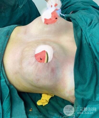 進行乳房縮小術