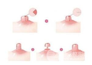 如何避免乳房縮小后的疤痕?