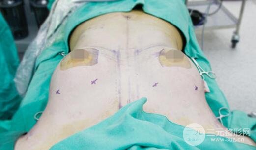 乳房縮小手術的特點是什么?