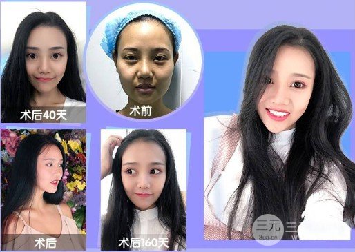 進口注射瘦臉多少錢