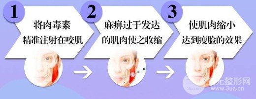 進口注射瘦臉是什么牌子