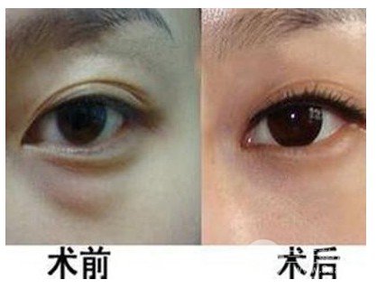 吸脂去眼袋多久能恢復(fù)