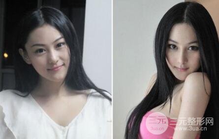 張馨予整容前和整容后的照片