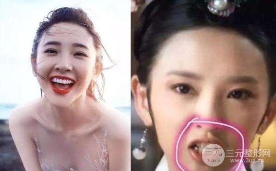 整牙真的能變漂亮嗎?