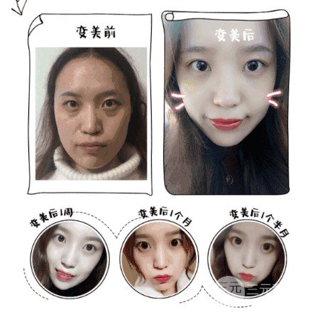 抽脂去眼袋費(fèi)用貴