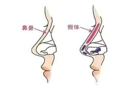 鼻部整形手術(shù)的可靠性