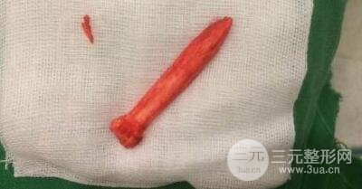 鼻部整形手術(shù)的可靠性