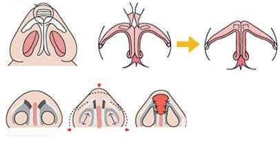 隆鼻后皮膚會變松嗎?
