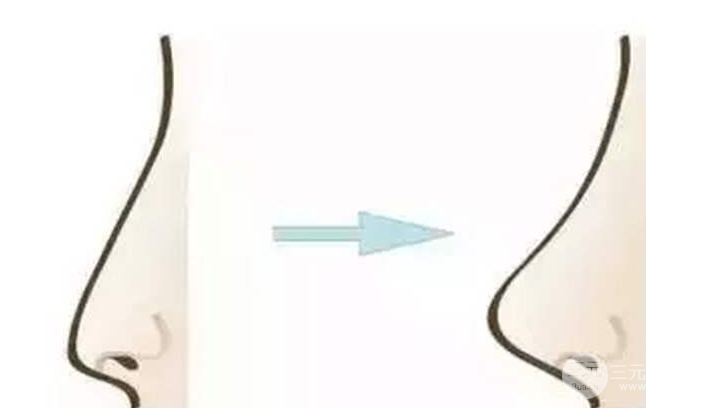 隆鼻假體壽命有多長