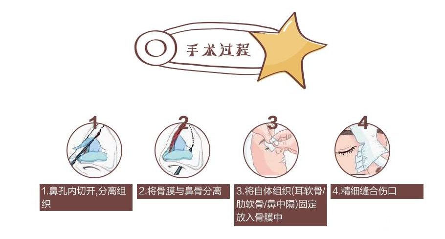 隆鼻假體壽命有多長