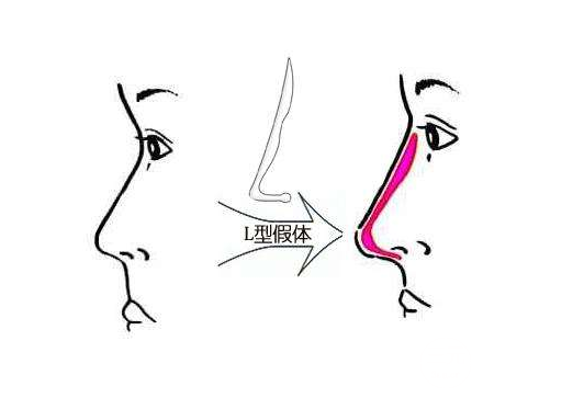 隆鼻假體壽命有多長