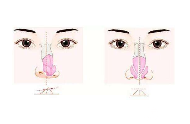 隆鼻假體壽命有多長
