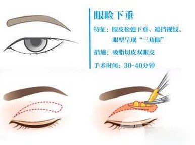 吸脂去眼袋成好嗎