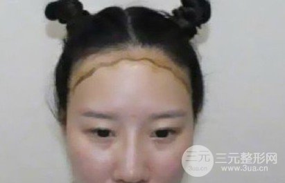 河南植發(fā)正規(guī)醫(yī)院收費標準