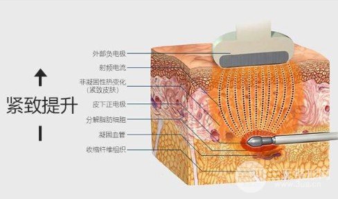 激光溶脂瘦臉果