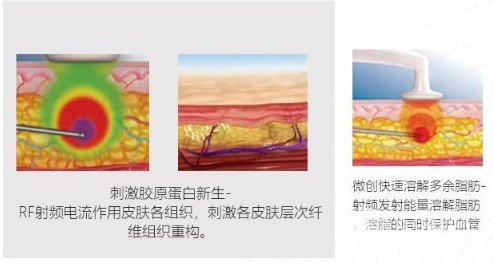 激光溶脂瘦臉果