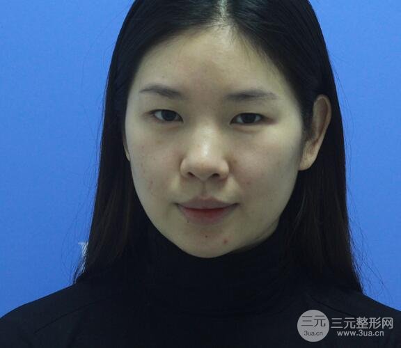 重慶park雙眼皮手術(shù)反饋