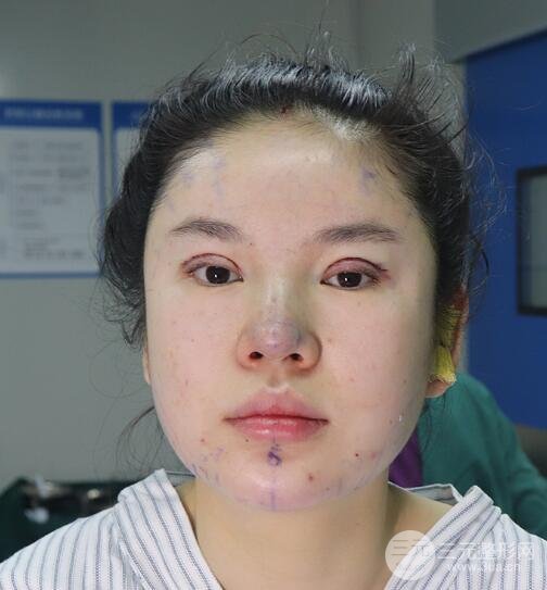 重慶park雙眼皮手術(shù)反饋