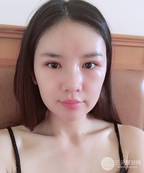 重慶park雙眼皮手術(shù)反饋