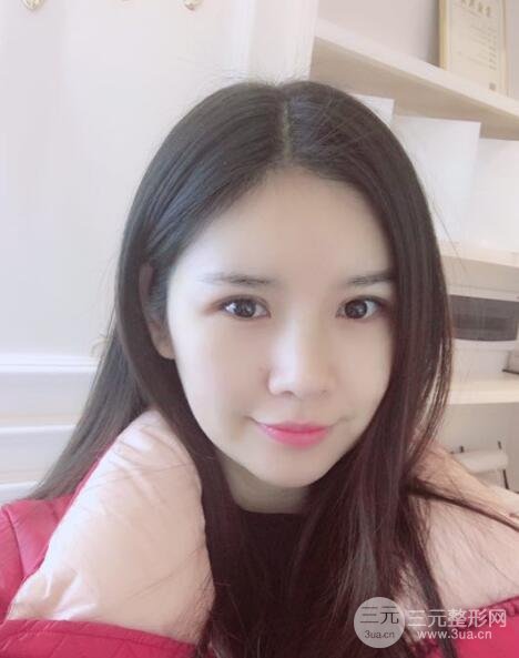 重慶park雙眼皮手術(shù)反饋