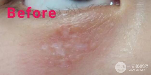 大家可以直觀的看到脂肪粒被祛除的過(guò)程