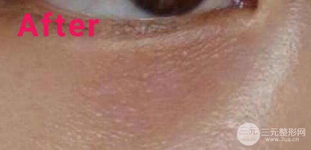 大家可以直觀的看到脂肪粒被祛除的過(guò)程