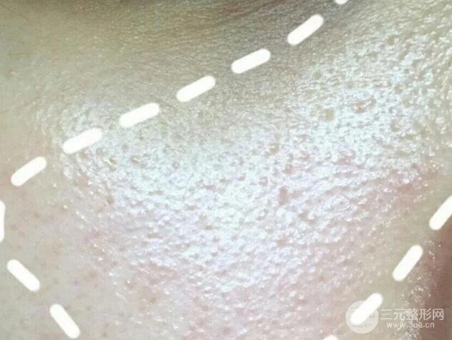 脂肪粒的自白：停用眼霜真的有用嗎？