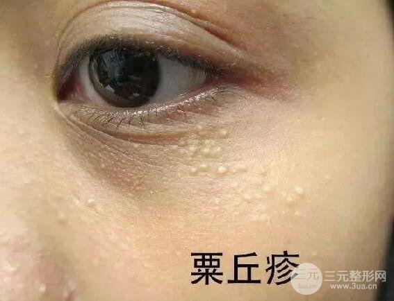 脂肪粒真的是因?yàn)樽o(hù)膚品過(guò)剩導(dǎo)致的嗎?