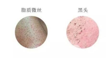 頑固黑頭：黑頭心中刺，拔掉萬般難！