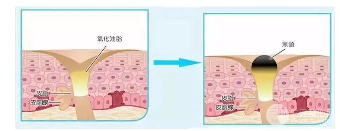 頑固黑頭：黑頭心中刺，拔掉萬般難！