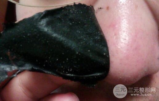 頑固黑頭：黑頭心中刺，拔掉萬般難！