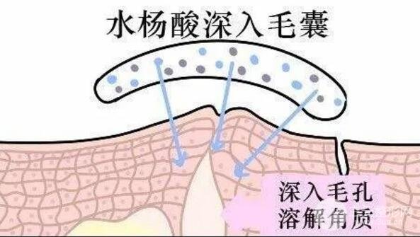 頑固黑頭：黑頭心中刺，拔掉萬般難！