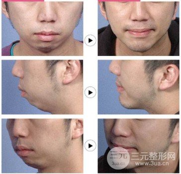 下巴吸脂多少錢