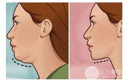 下巴吸脂多少錢