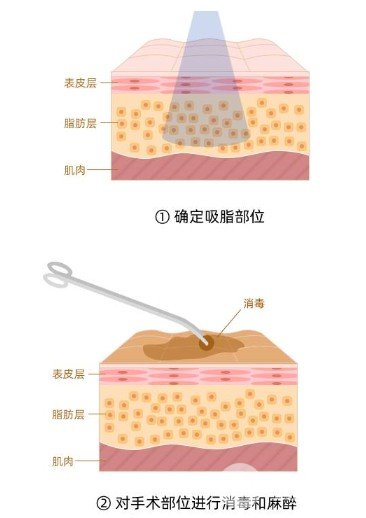 下巴吸脂多少錢