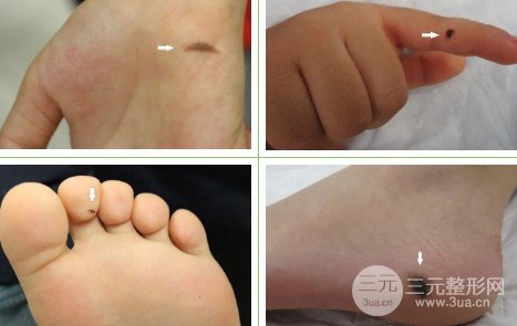 去痦子的方法