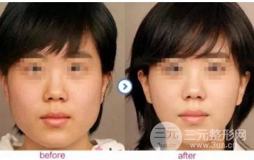 打****注射瘦臉的價(jià)格貴嗎