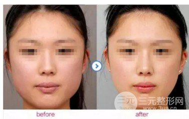 打****注射瘦臉的價(jià)格貴嗎