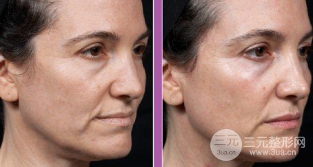 熱瑪吉全臉部價格表