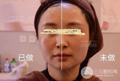 熱瑪吉全臉部價格表