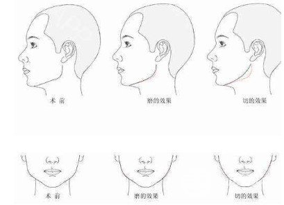 下頜角切除一般多少錢