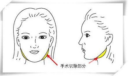 下頜角切除一般多少錢