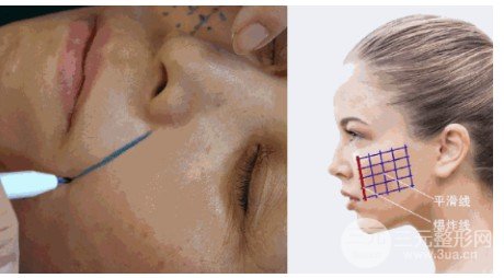 埋線除皺和熱瑪吉哪個(gè)后期果好