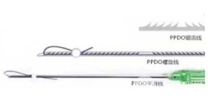 埋線除皺和熱瑪吉哪個(gè)后期果好