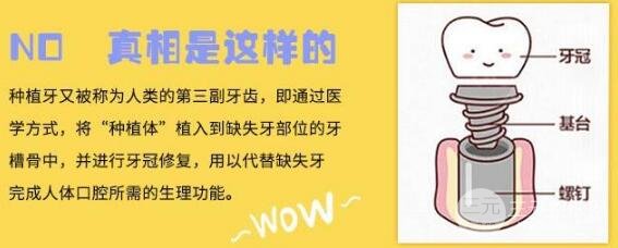 什么叫種植牙