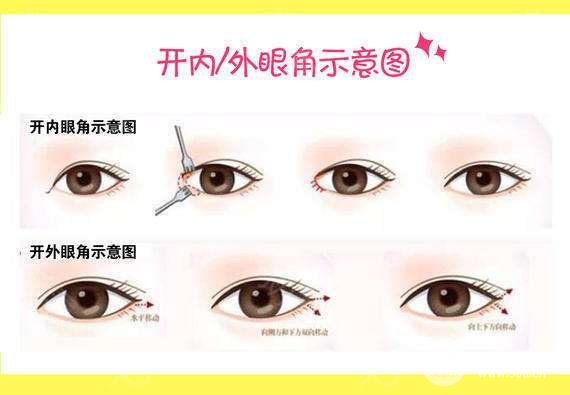開(kāi)眼角有什么好處