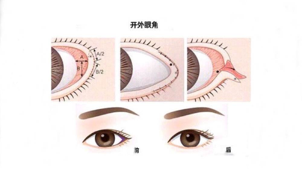 開(kāi)眼角需要多少錢(qián)