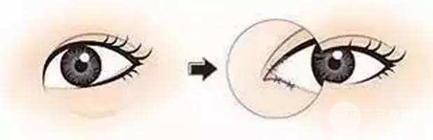 開(kāi)眼角手術(shù)多久能恢復(fù)