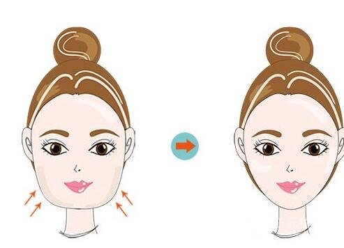 激光溶脂瘦臉怎么樣?