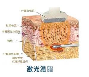 激光溶脂瘦臉恢復(fù)期注意事項(xiàng)有哪些?